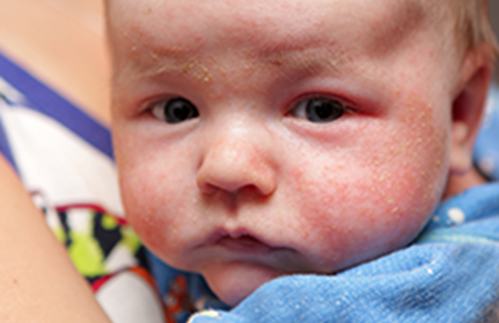 Baby eczema image
